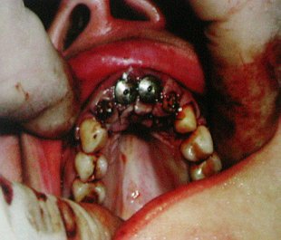 Протезирование верхней челюсти имплантатами компании ASTRA TECH AB - Cпециальный репортаж РМС-Экспо